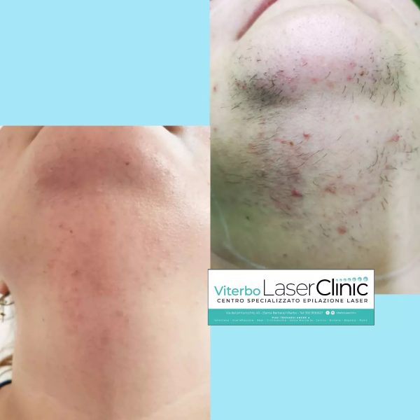 risultati-prima-dopo-viterbo-laser-clinic (10)