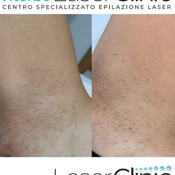 risultati-prima-dopo-viterbo-laser-clinic (11)