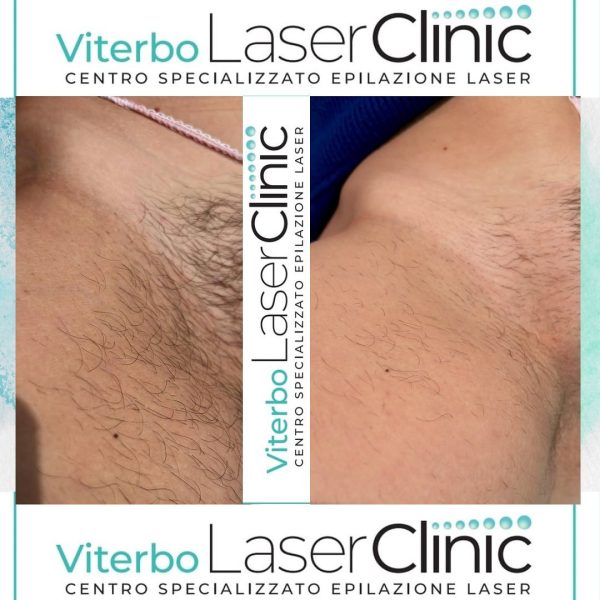 risultati-prima-dopo-viterbo-laser-clinic (13)