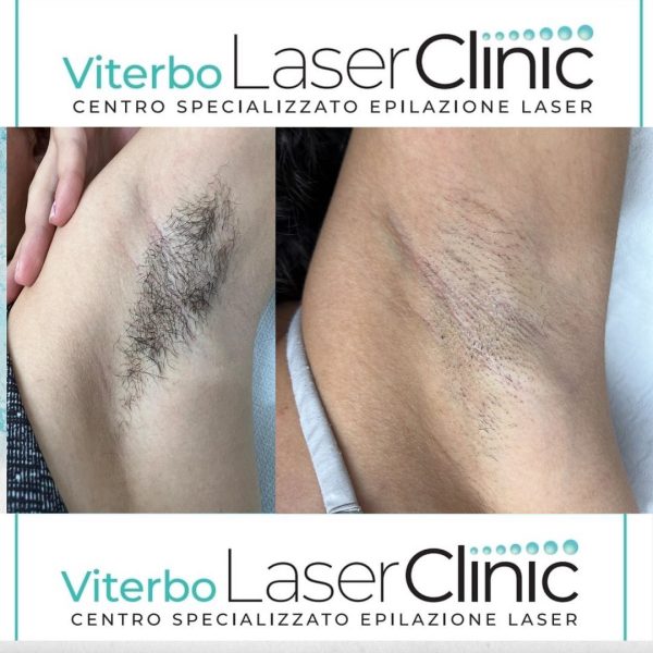 risultati-prima-dopo-viterbo-laser-clinic (14)