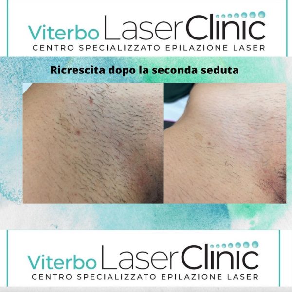 risultati-prima-dopo-viterbo-laser-clinic (15)