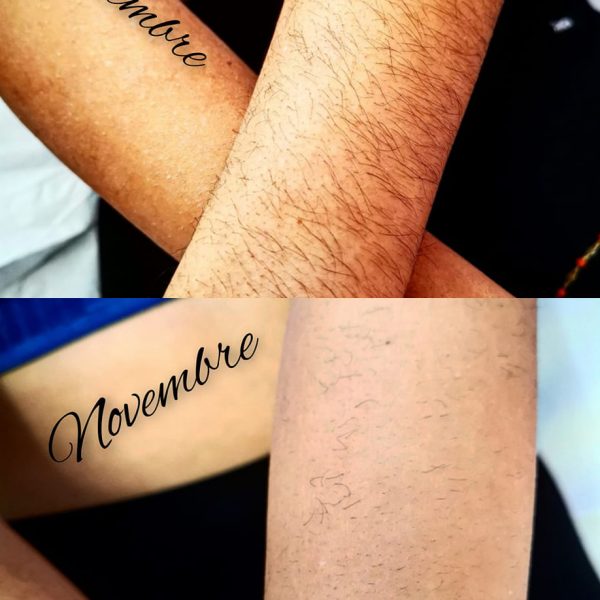 risultati-prima-dopo-viterbo-laser-clinic (18)