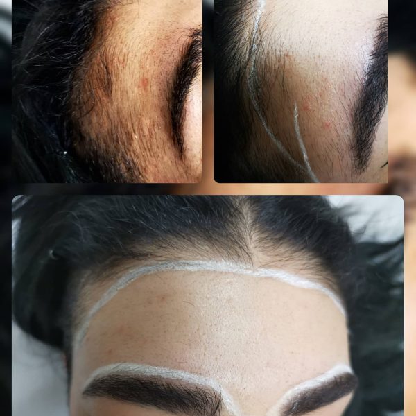 risultati-prima-dopo-viterbo-laser-clinic (2)