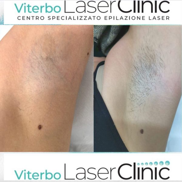 risultati-prima-dopo-viterbo-laser-clinic (20)