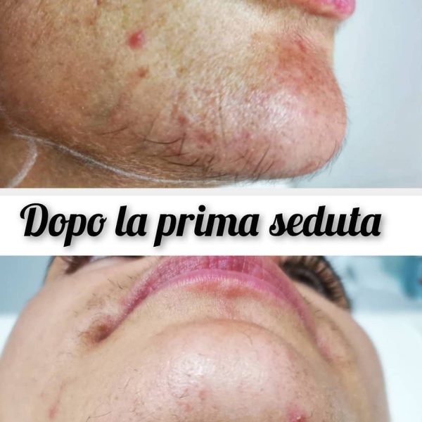 risultati-prima-dopo-viterbo-laser-clinic (3)