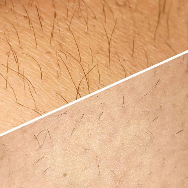 risultati-prima-dopo-viterbo-laser-clinic (4)