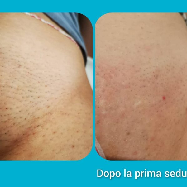 risultati-prima-dopo-viterbo-laser-clinic (5)