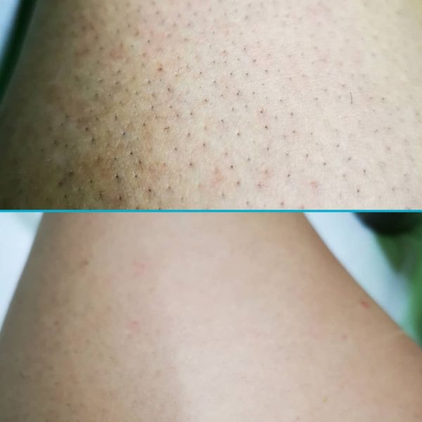 risultati-prima-dopo-viterbo-laser-clinic (6)