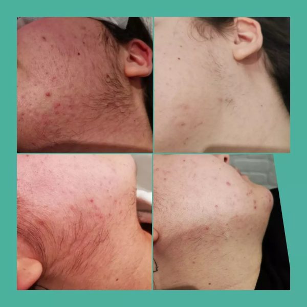 risultati-prima-dopo-viterbo-laser-clinic (7)