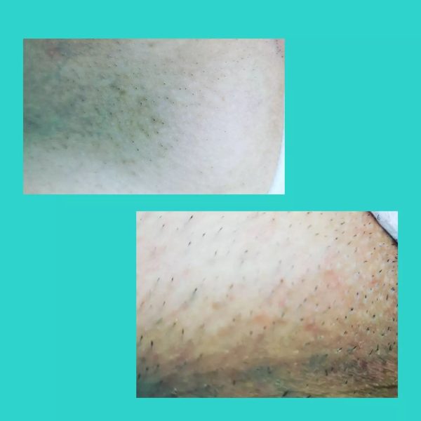 risultati-prima-dopo-viterbo-laser-clinic (8)
