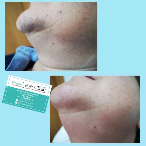 risultati-prima-dopo-viterbo-laser-clinic (9)